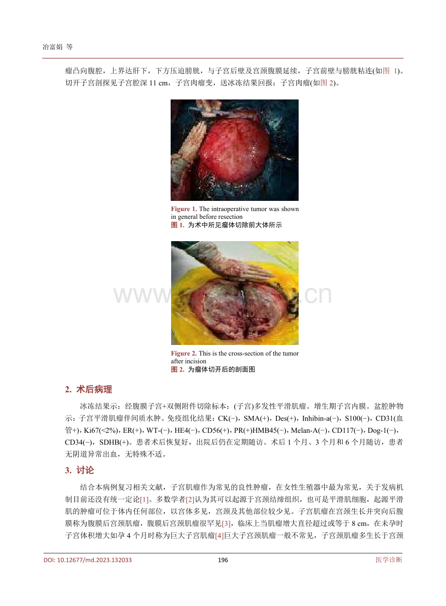 腹膜后巨大子宫颈梭形细胞肿瘤一例并文献复习.pdf_第3页