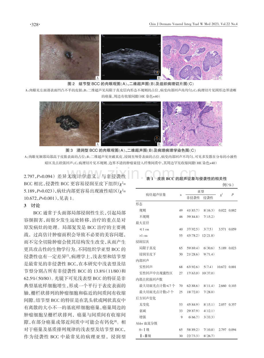 高频超声鉴别侵袭性与非侵袭性皮肤基底细胞癌的应用价值.pdf_第3页