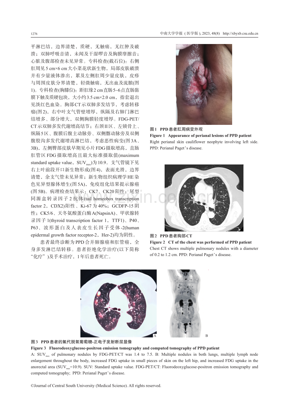 肛周Paget病合并肺腺癌和肛管癌1例并文献复习.pdf_第3页