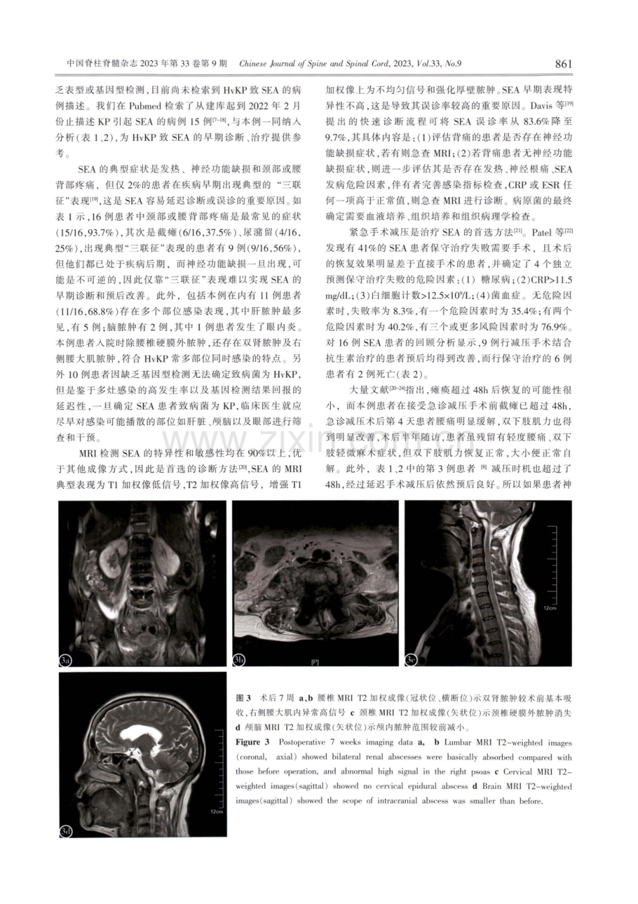 高毒力肺炎克雷伯菌致硬脊膜外脓肿1例报道.pdf_第3页