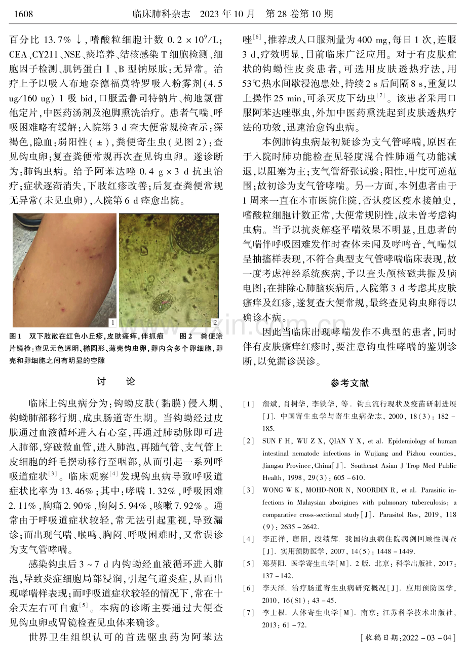 钩虫病致哮喘1例分析.pdf_第2页