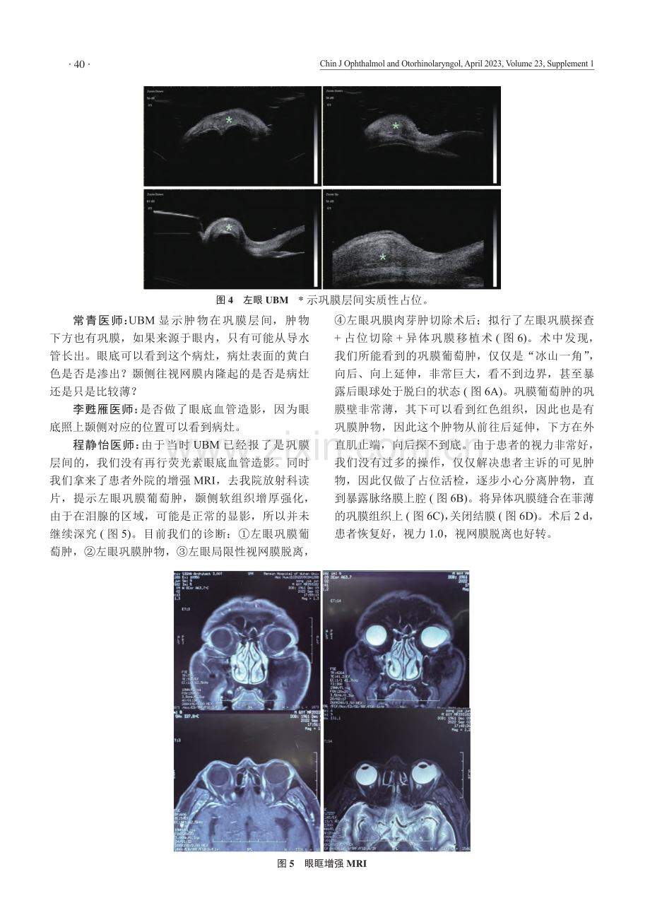 巩膜葡萄肿1例.pdf_第3页