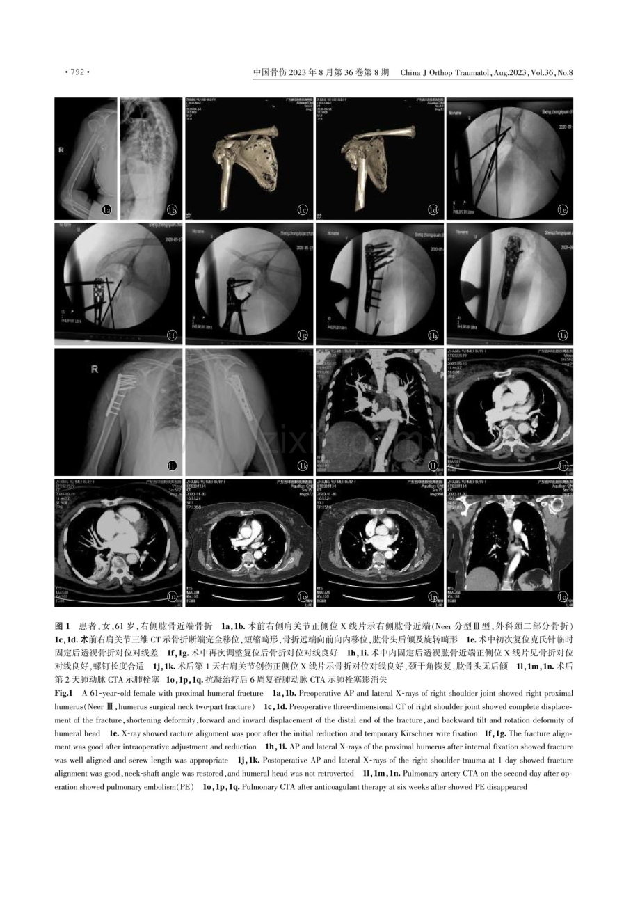 肱骨近端骨折术后并发肺动脉栓塞1例.pdf_第3页
