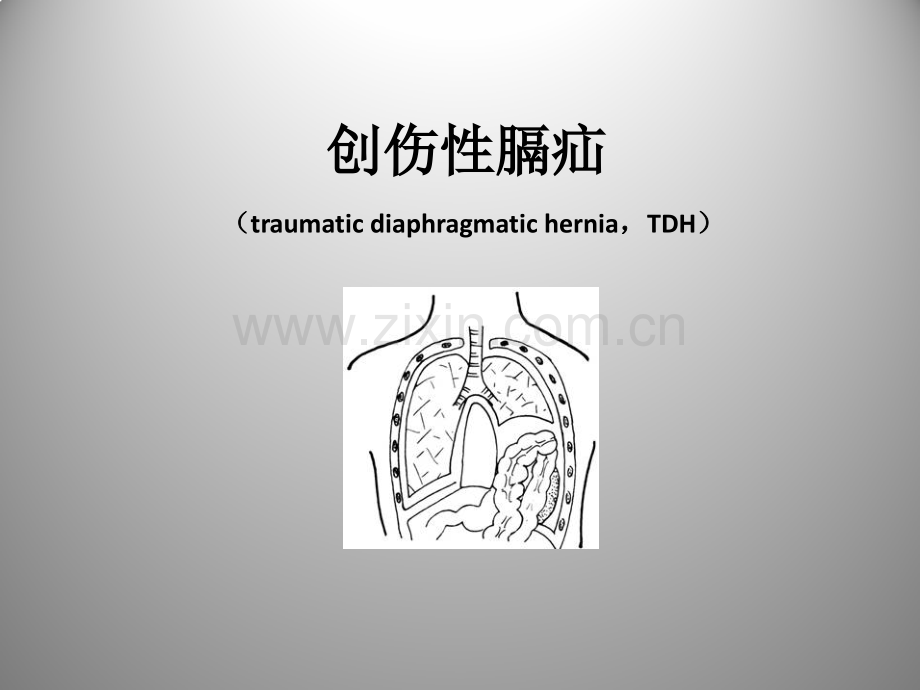 创伤性膈疝.pptx_第1页