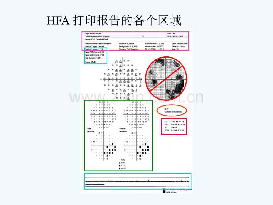 视野报告分析简单说明-PPT.ppt_第3页