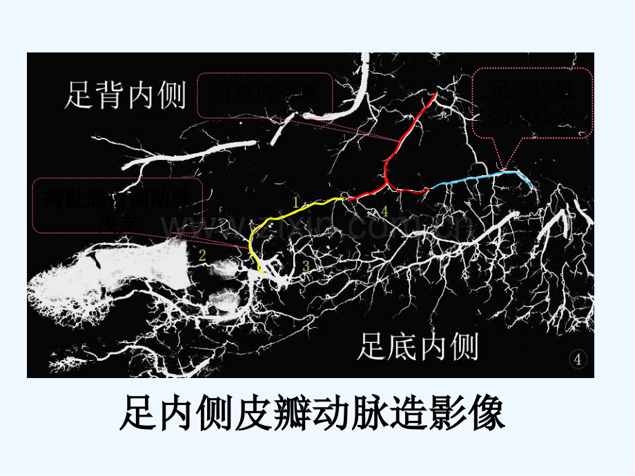 足内侧岛状皮瓣的解剖与临床应用-PPT.pptx_第3页