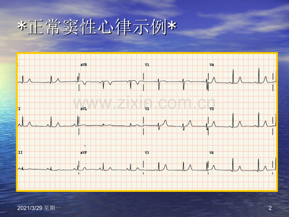 临床常见心电图判读.ppt_第2页