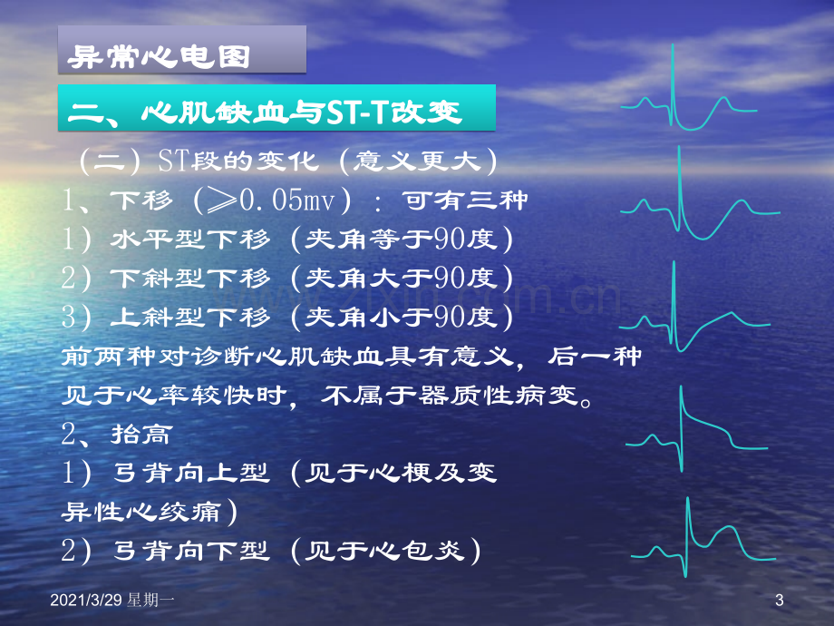 临床常见心电图判读.ppt_第3页