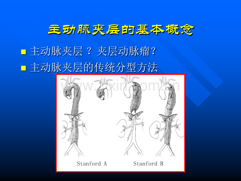 主动脉夹层分型及治疗.ppt_第2页