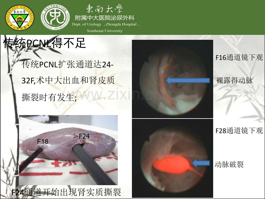 精选微创经皮肾镜课件.pptx_第3页