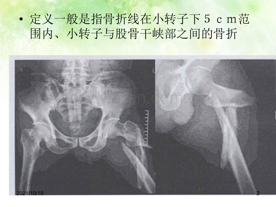 股骨转子下骨折.ppt_第2页