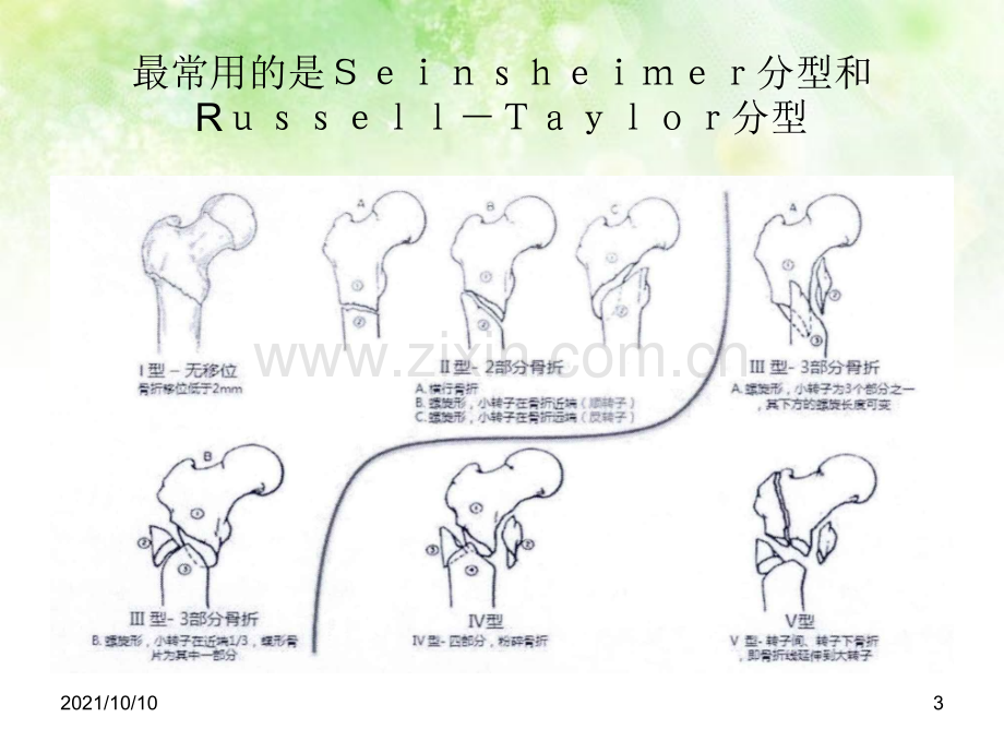 股骨转子下骨折.ppt_第3页