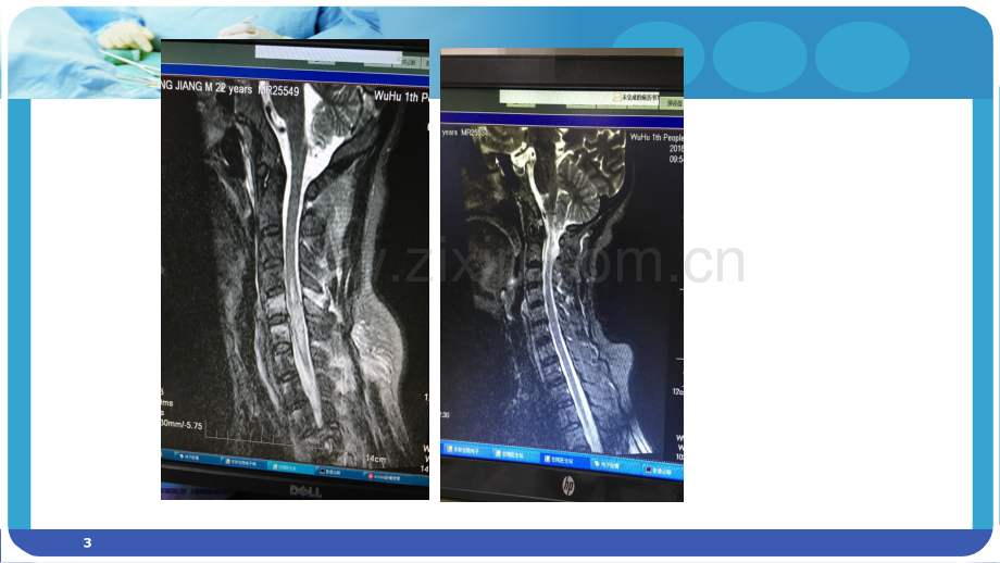 颈髓损伤的护理查房.ppt_第3页