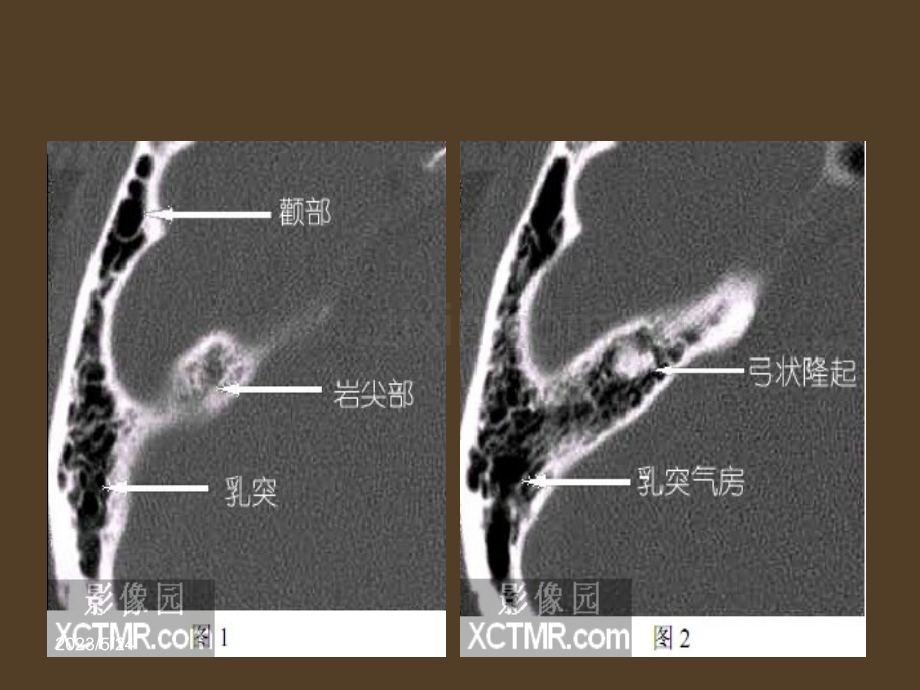 耳部最详细CT解剖.ppt_第2页