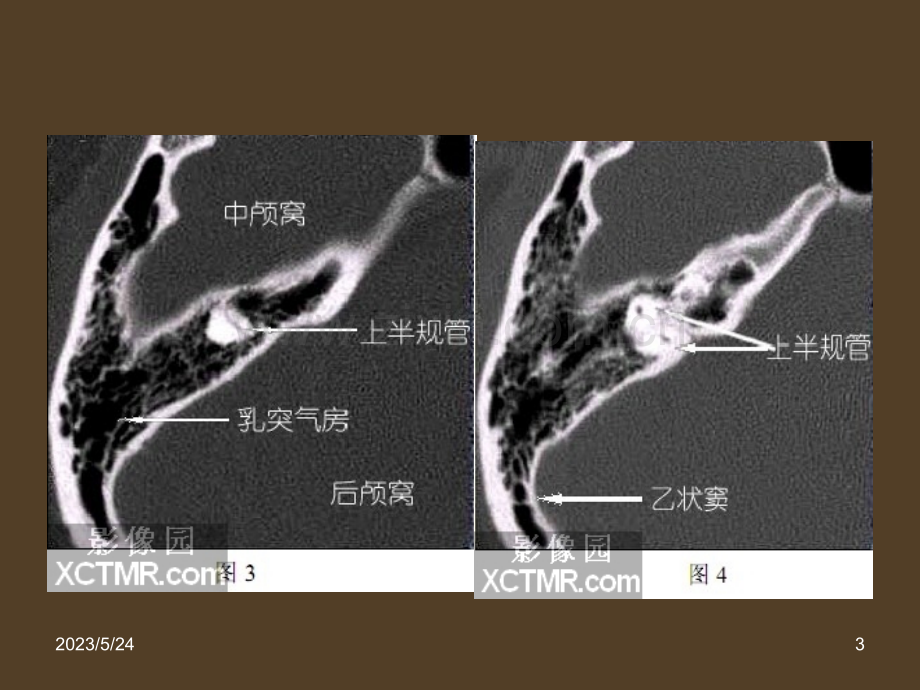 耳部最详细CT解剖.ppt_第3页