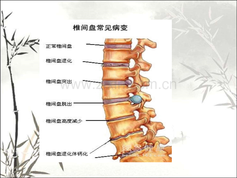 颈椎病的护理查房元明.pptx_第2页