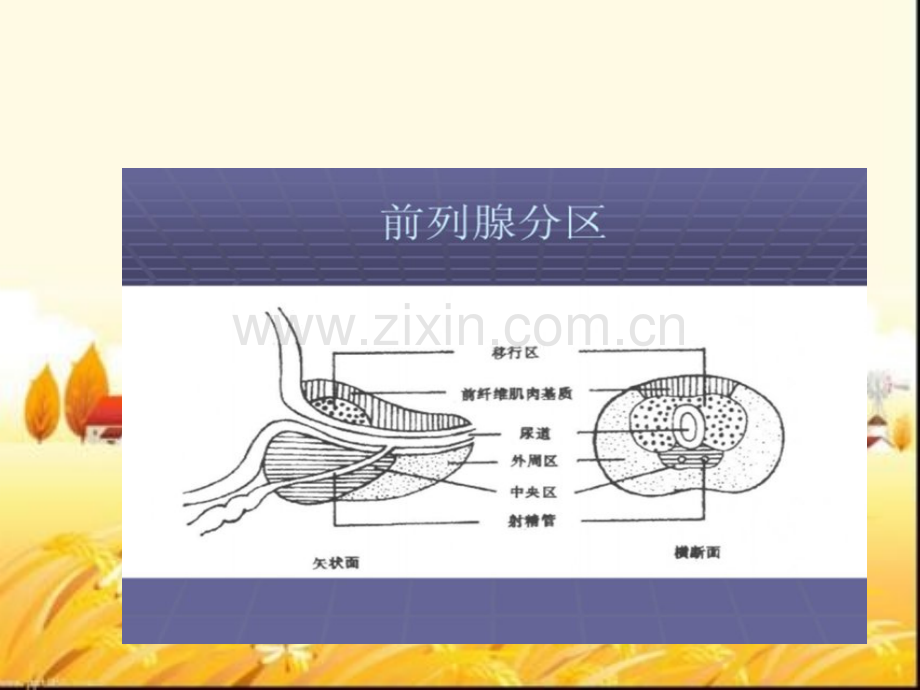 良性前列腺增生病正式稿.pptx_第3页