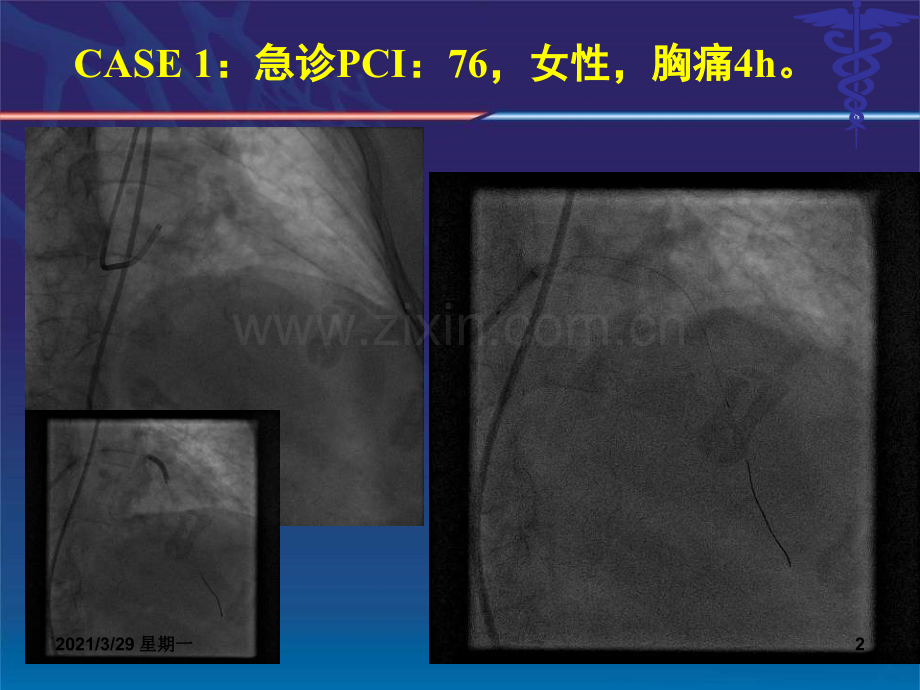 直接PCI术中无复流慢血流的应对策略.ppt_第2页