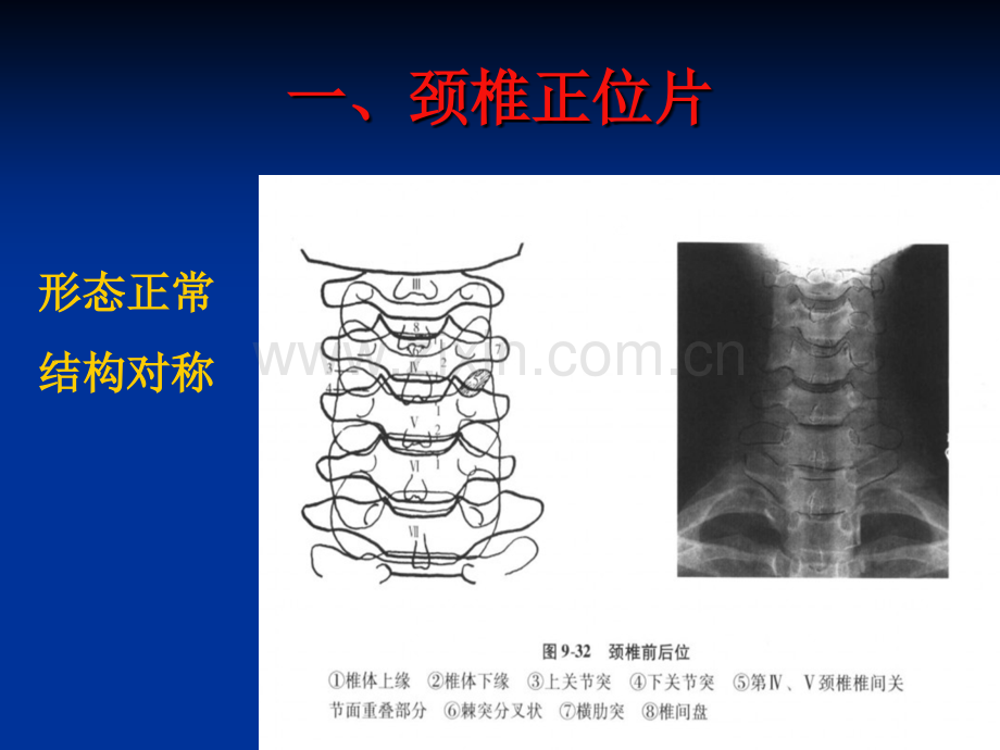 颈椎六位片.ppt_第3页