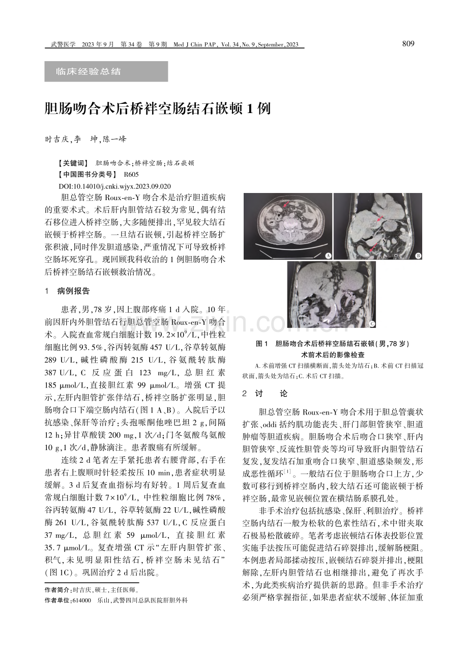 胆肠吻合术后桥袢空肠结石嵌顿1例.pdf_第1页