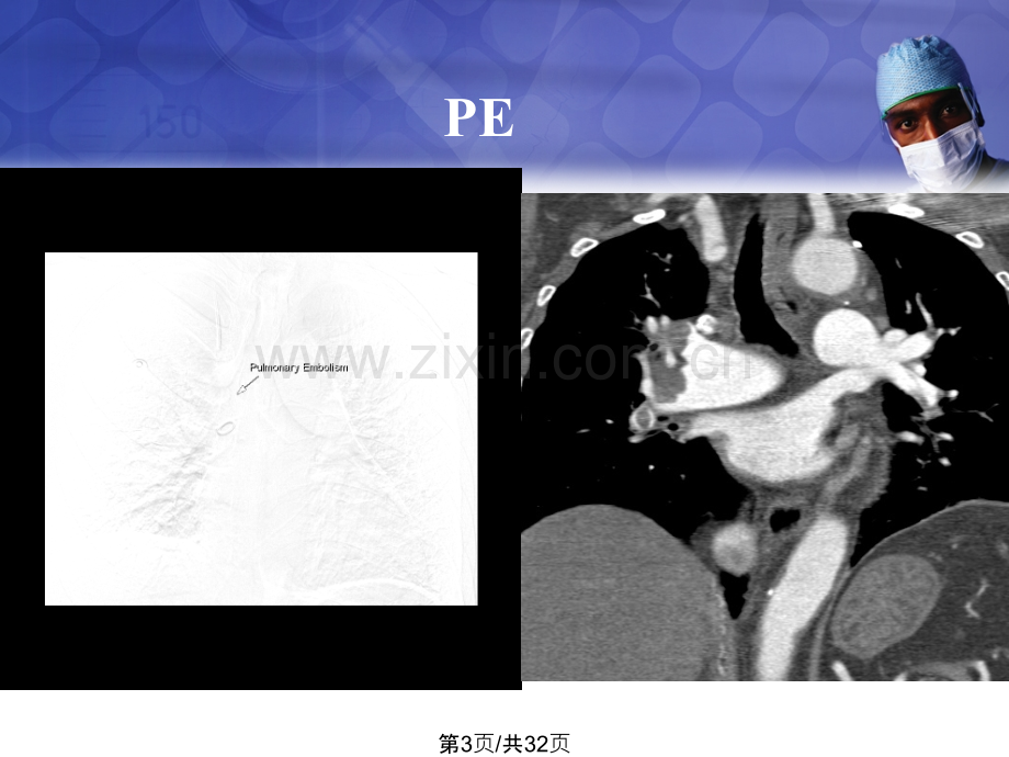 DVT及PE介入治疗的临床效果及风险.ppt_第3页