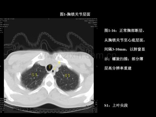 最全胸部CT肺段划分.ppt