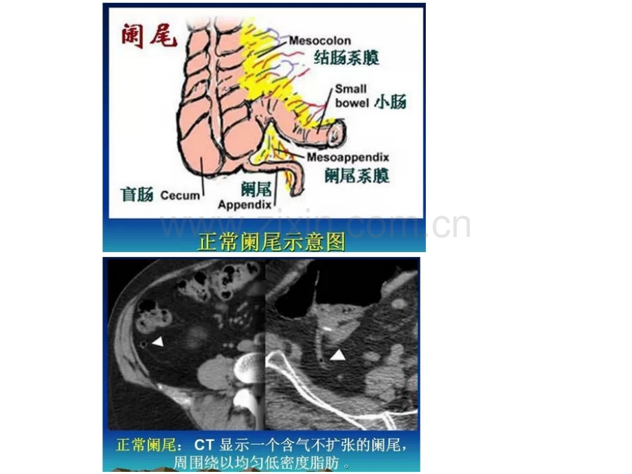 急腹症的CT诊断与鉴别诊断.pptx_第3页