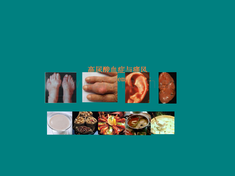 高尿酸血症与痛风hyperuricemia&gout.ppt_第1页