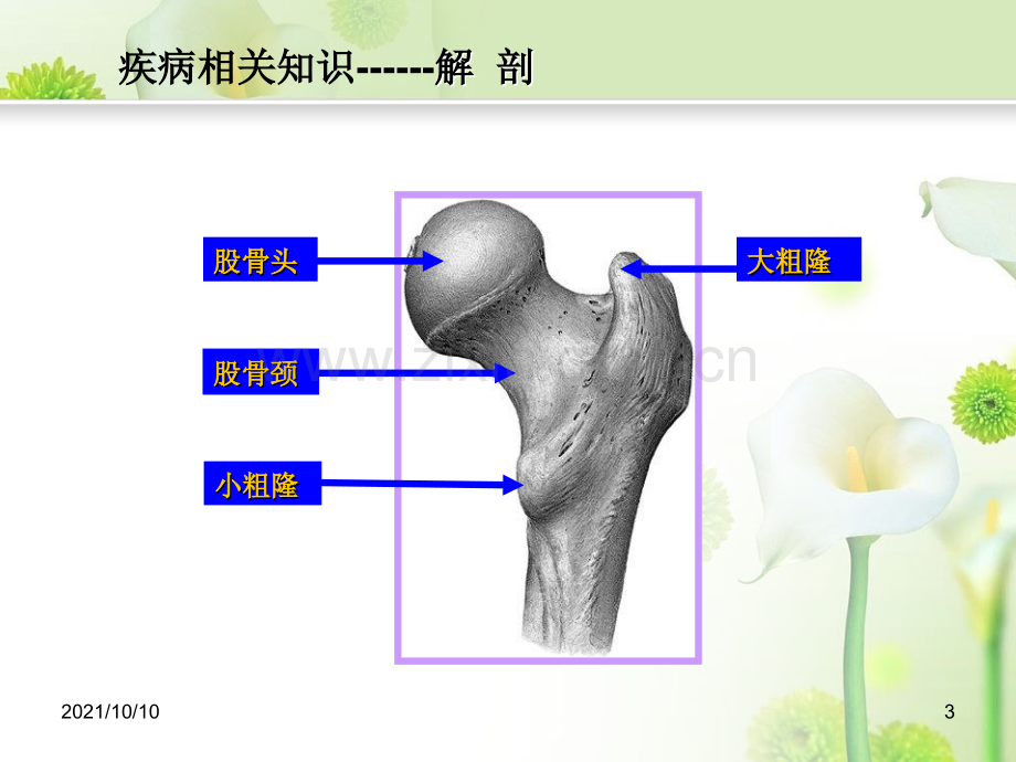 股骨粗隆间骨折护理查房.ppt_第3页