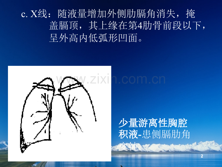 胸腔积液的影像诊断.ppt_第2页