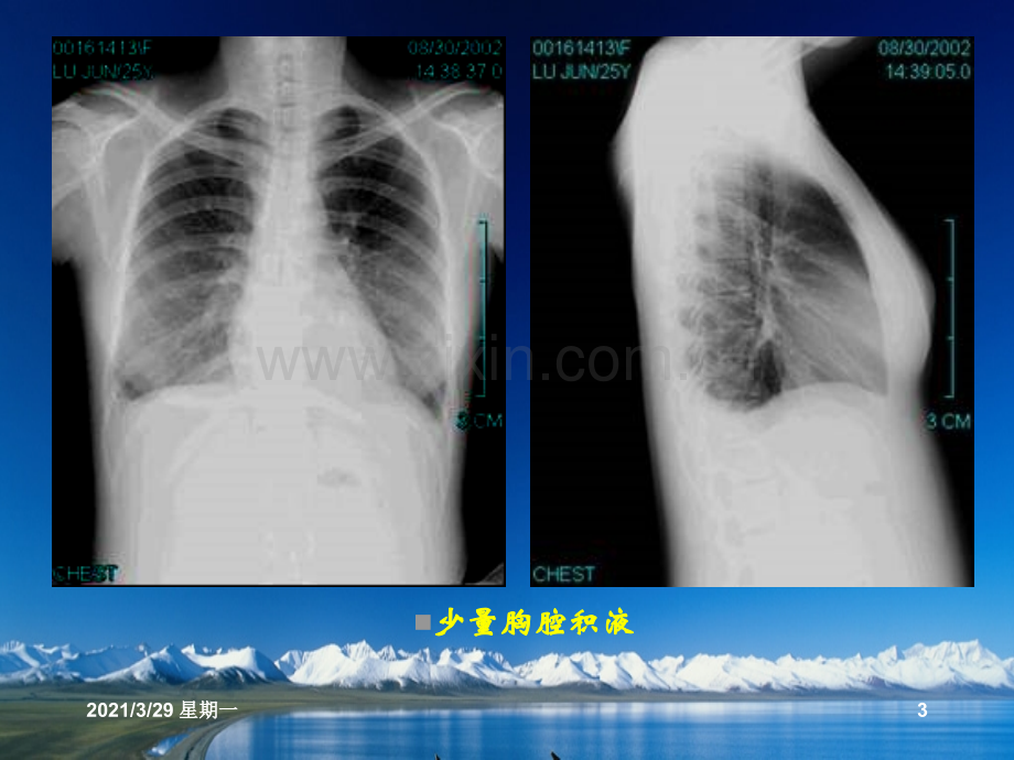 胸腔积液的影像诊断.ppt_第3页