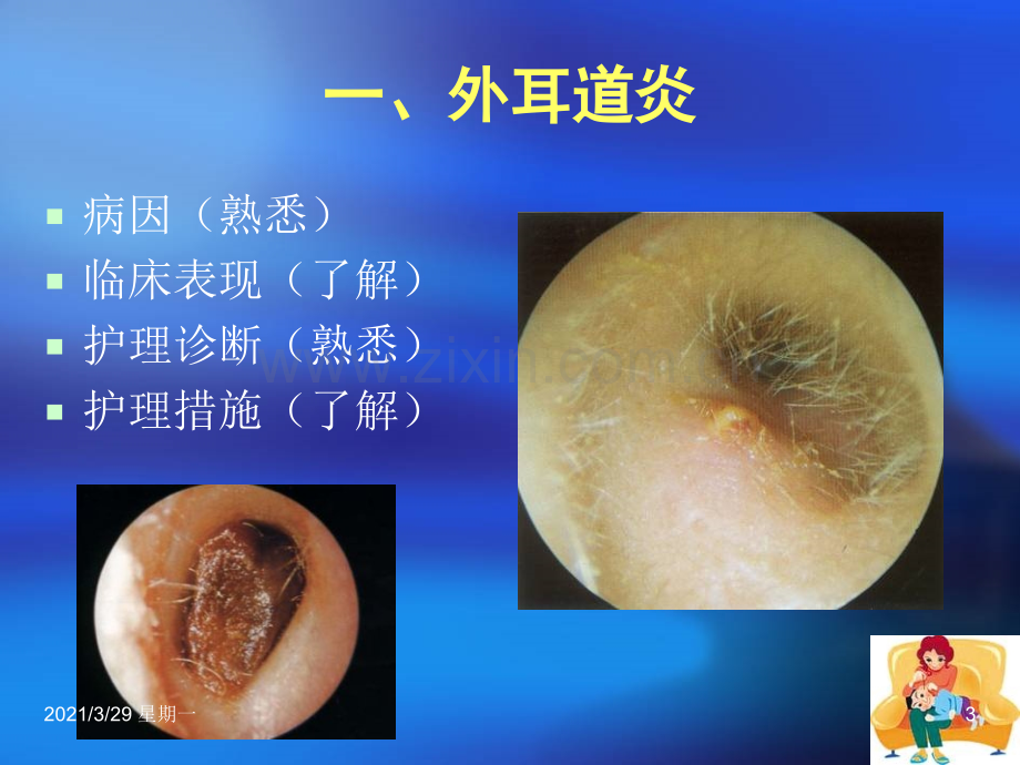 耳部常见疾病护理常规.ppt_第3页