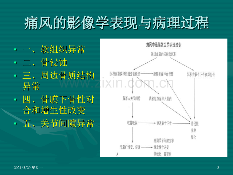 痛风的影像学表现及进展--何永胜.ppt_第2页