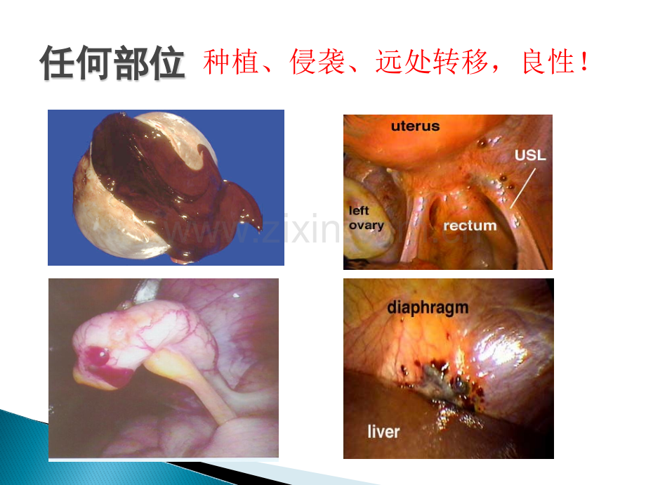 子宫内膜异位症2016.pptx_第3页