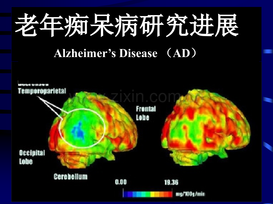 2019老年痴呆研究进展化学.ppt_第1页