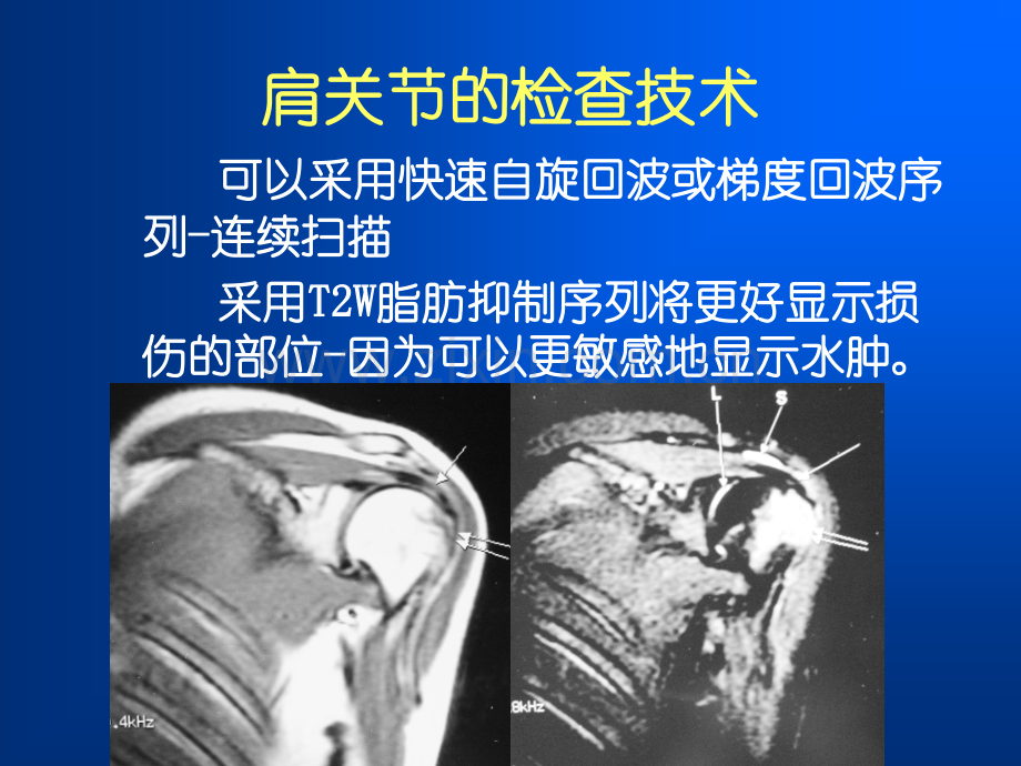 肩袖损伤MRI诊断.ppt_第3页