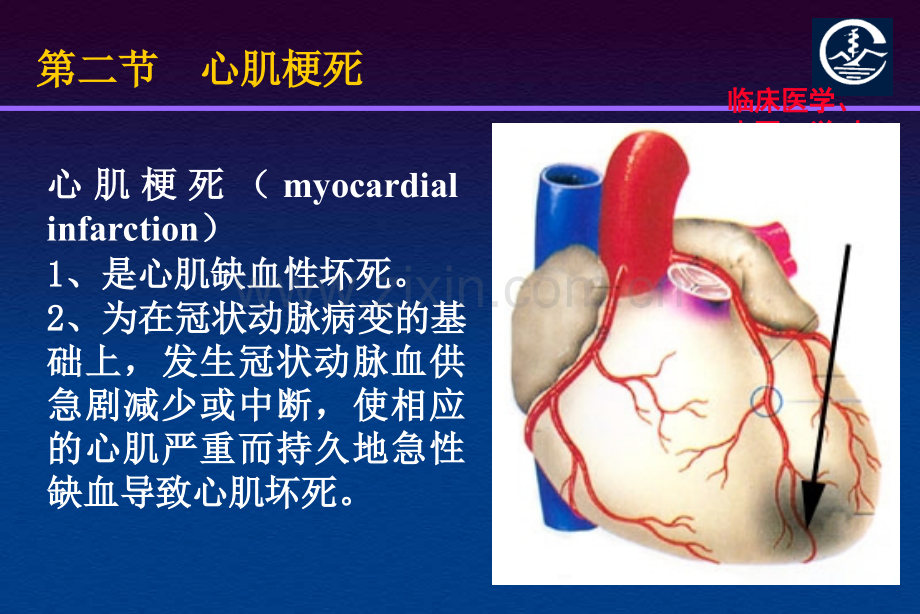 冠心病心梗.ppt_第3页