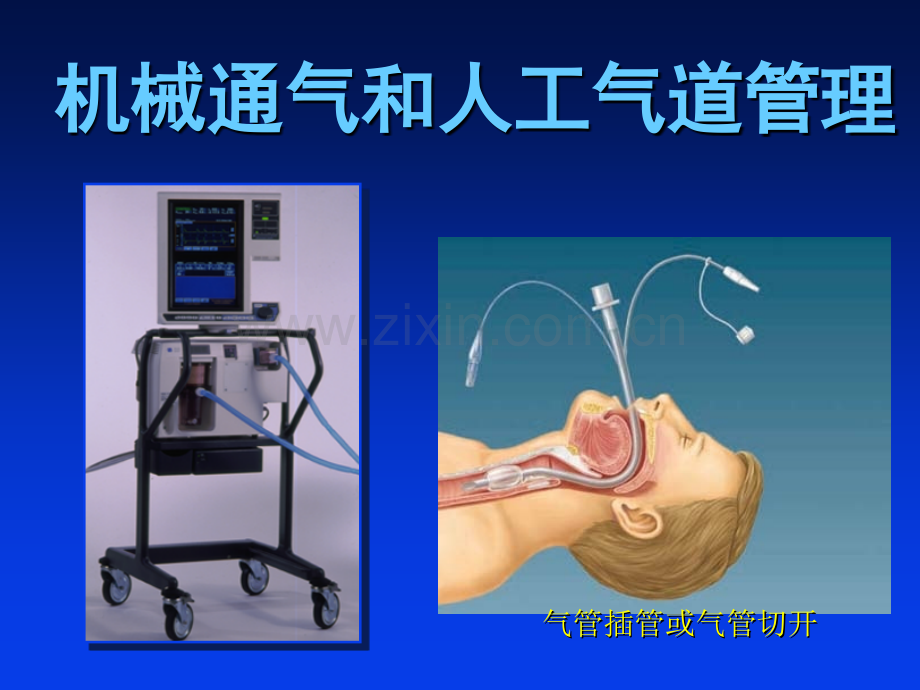 机械通气和人工气道管理.ppt_第1页