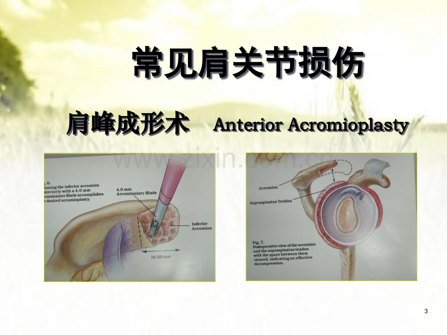 肩关节镜手术期护理要点.pptx_第3页