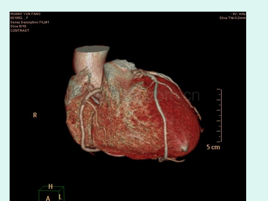 心脏冠状动脉CTA成.ppt_第3页