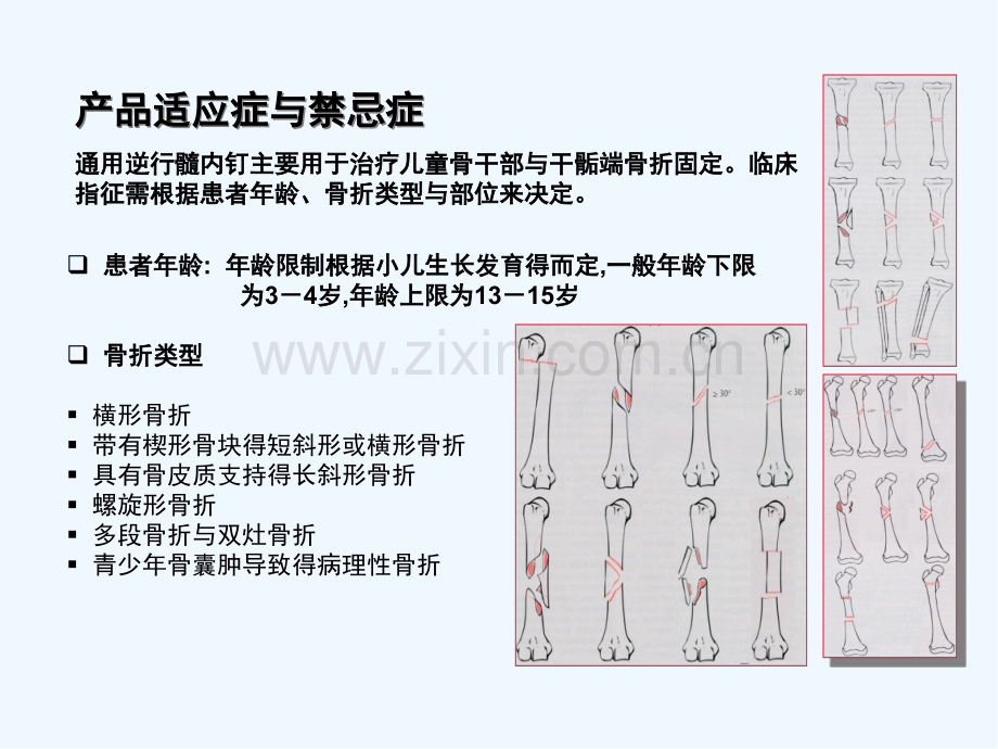 逆行髓内钉小儿弹性髓内钉ppt.pptx_第3页