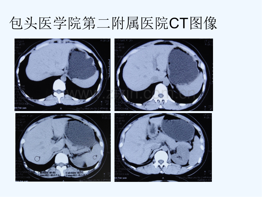 腹膜后非典型性孤立性纤维性肿瘤病例讨论ppt.pptx_第2页