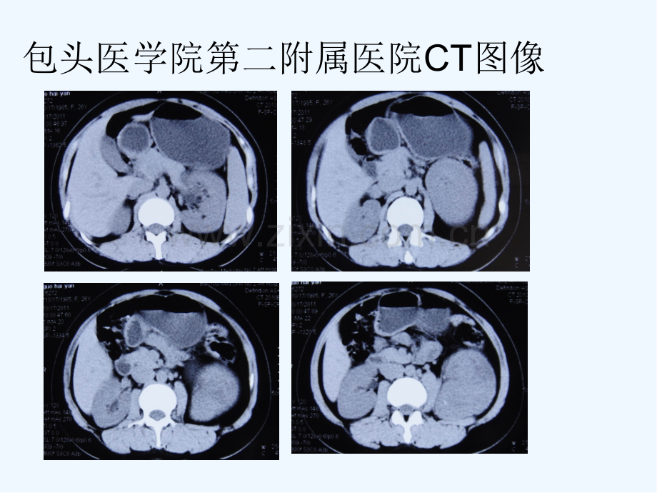 腹膜后非典型性孤立性纤维性肿瘤病例讨论ppt.pptx_第3页