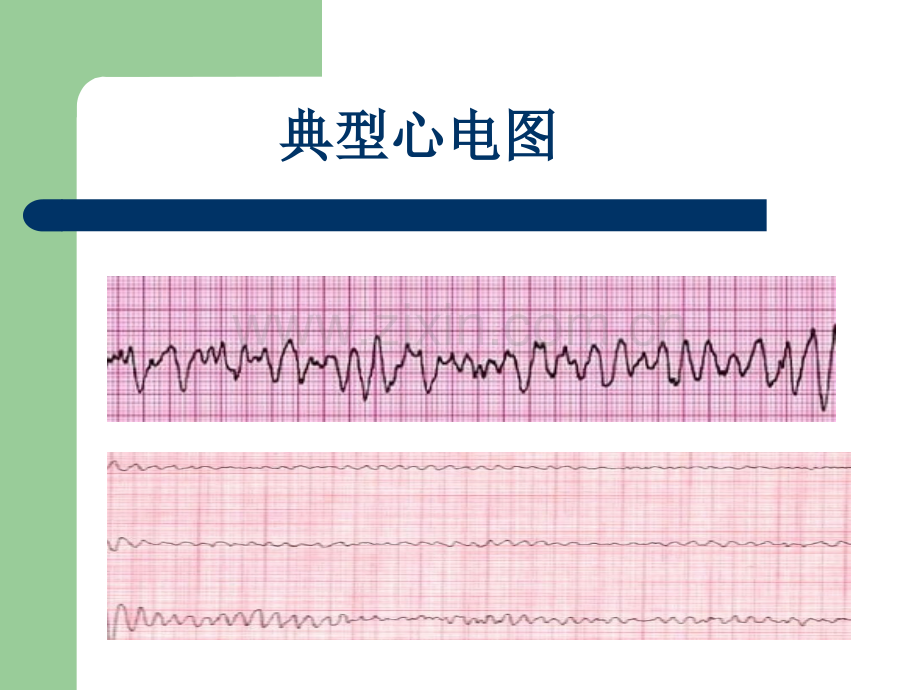 心脏电除颤后患者的护理.ppt_第3页