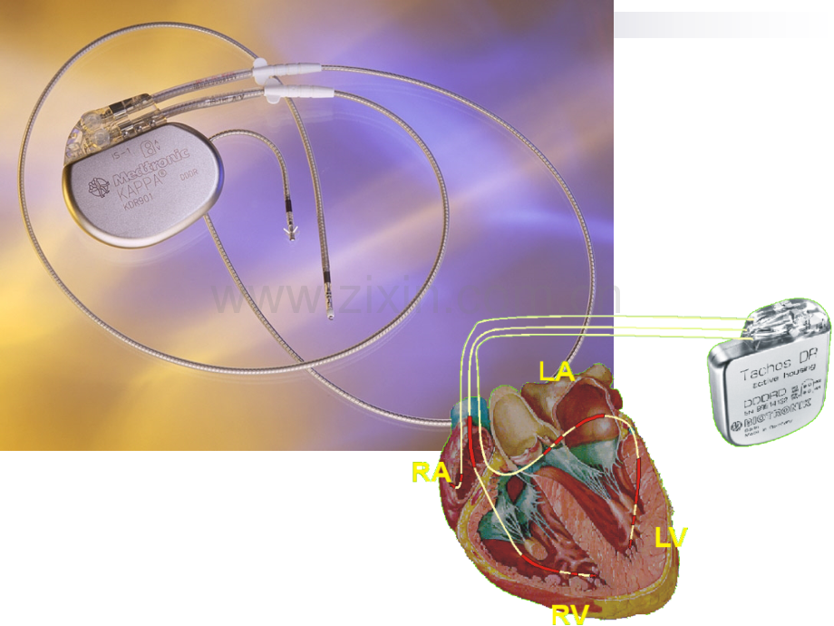 心脏起搏器和除颤器的学习.ppt.ppt_第2页
