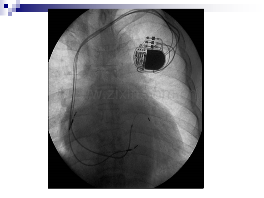 心脏起搏器和除颤器的学习.ppt.ppt_第3页