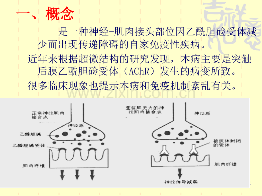 重症肌无力的护理.ppt_第2页