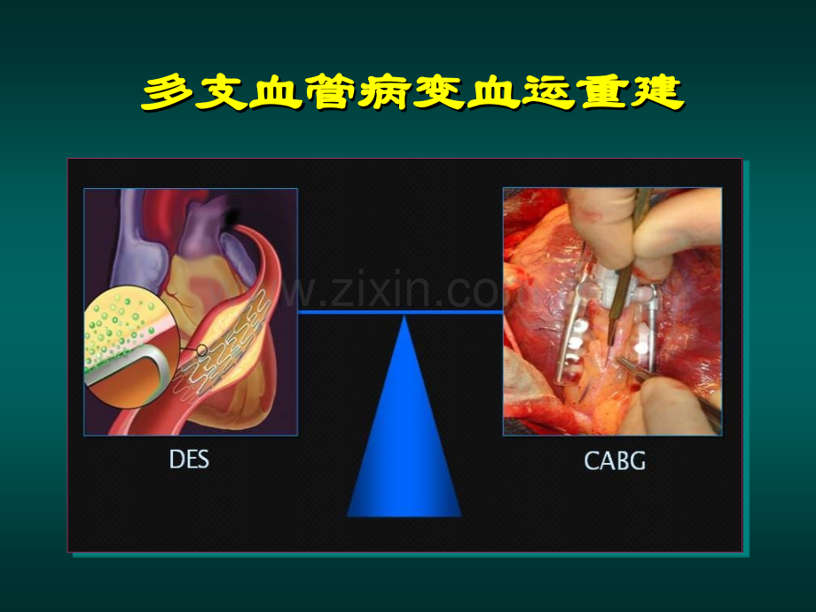 冠心病介入治疗再认识.ppt_第2页