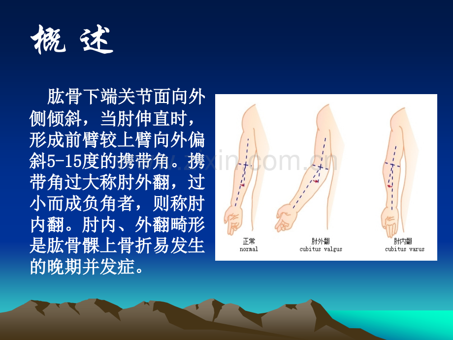 肱骨髁上骨折.ppt_第3页