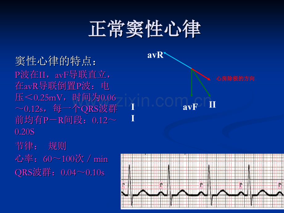 恶性心律失常的识别与护理.ppt_第3页